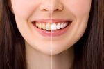 bioclear vs. veneers which cosmetic fix is better for chipped teeth