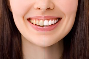 bioclear vs. veneers which cosmetic fix is better for chipped teeth