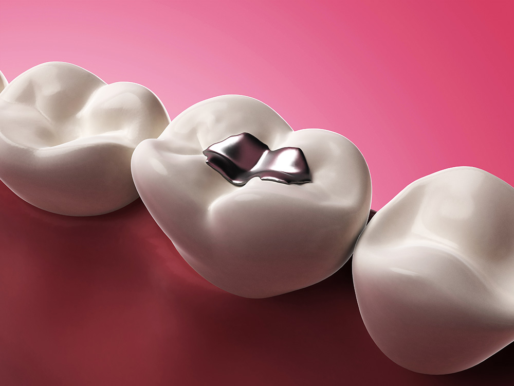 dental filling near you in richmond
