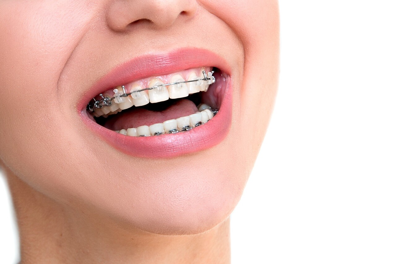 a girl is smiling after getting orthodontics treatment