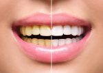 why do overly white teeth sometimes look unnatural