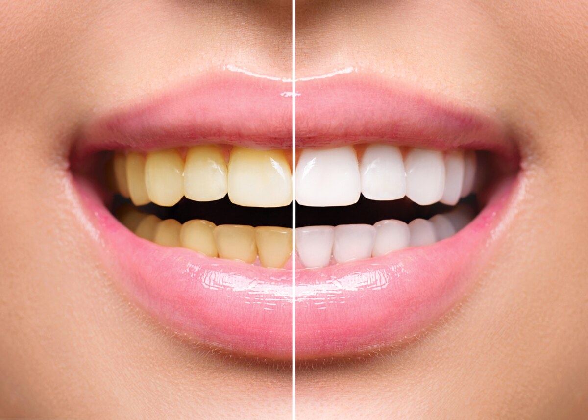 why do overly white teeth sometimes look unnatural